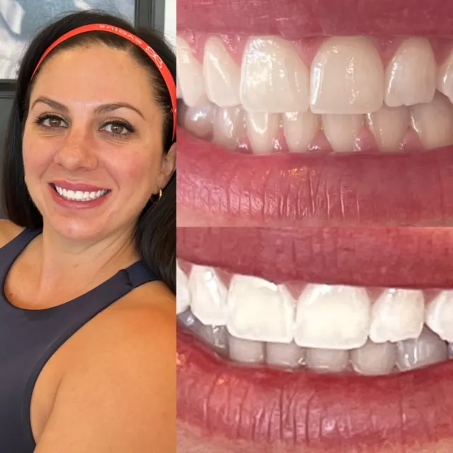 30755 understanding teeth whitening