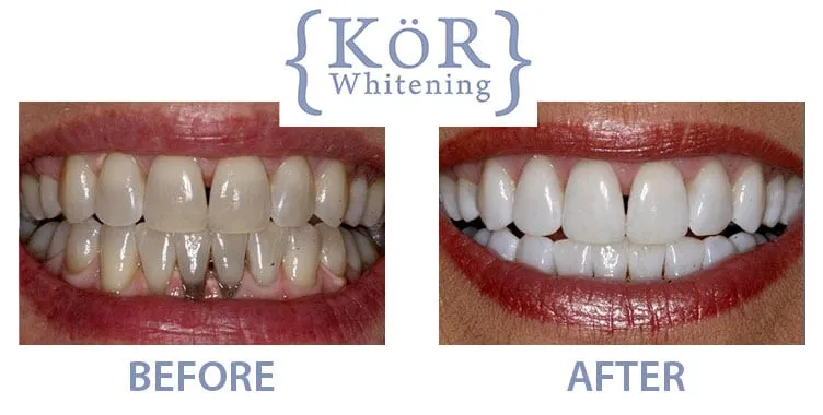 30756 at home teeth whitening kits