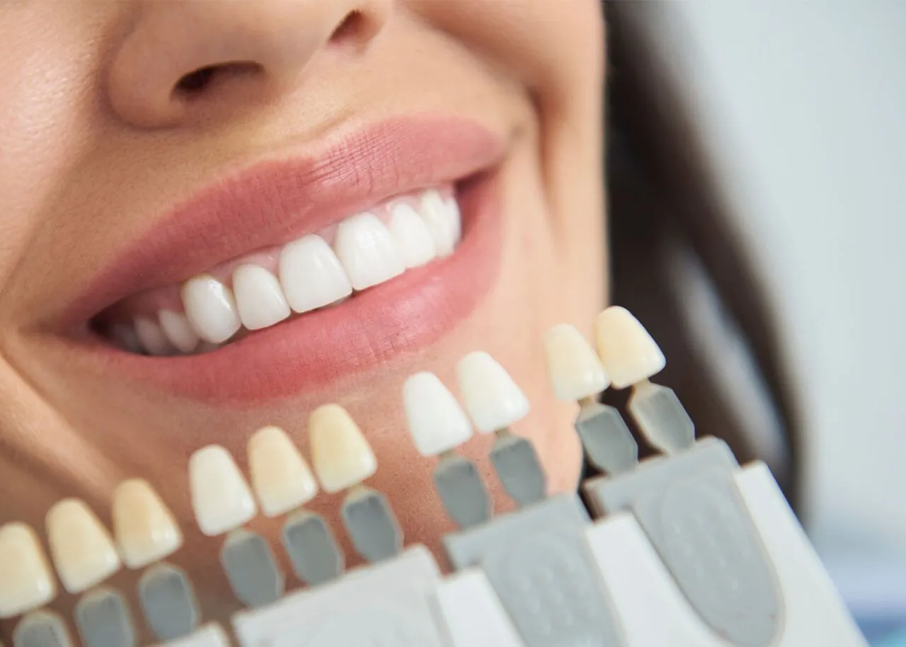 30756 professional teeth whitening