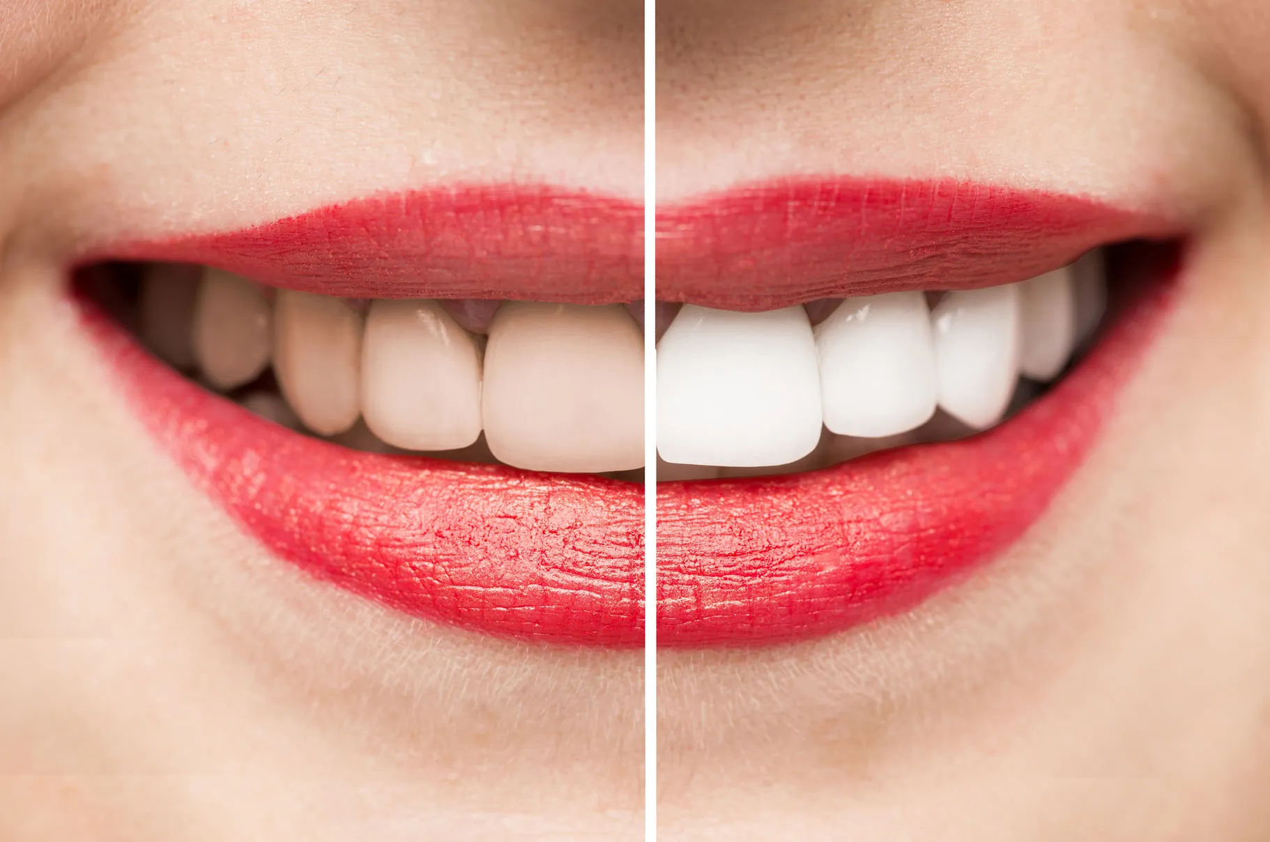30759 salisbury teeth whitening sensitivity tips