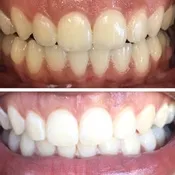 30767 teeth whitening brighton patient smile