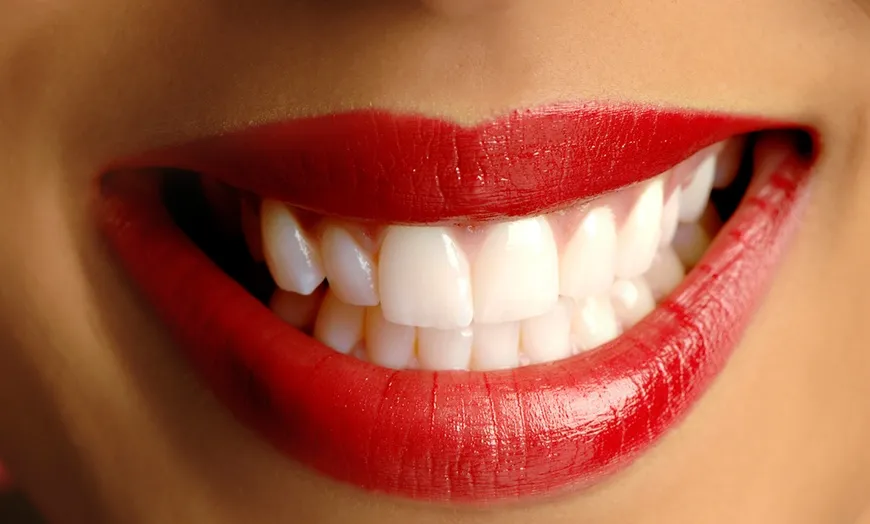 30767 teeth whitening groupon comparison