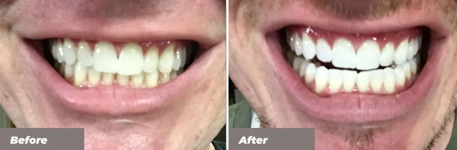 30780 teeth whitening tallaght clinic