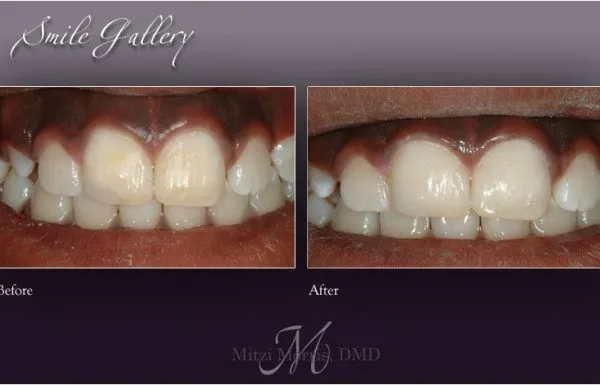 30785 zoom teeth whitening atlanta 2