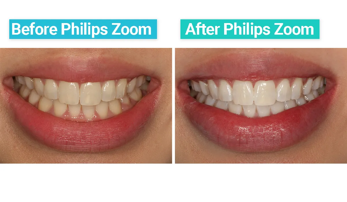 30785 zoom teeth whitening atlanta 4