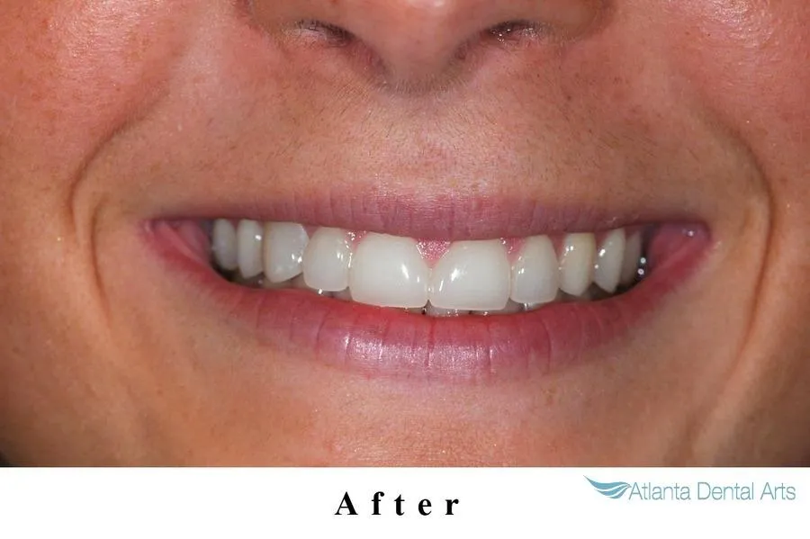 30785 zoom teeth whitening atlanta 5