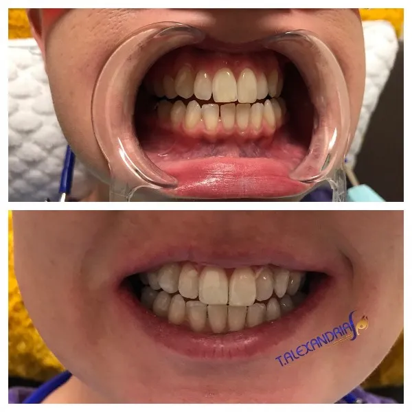 30786 foods to avoid teeth whitening