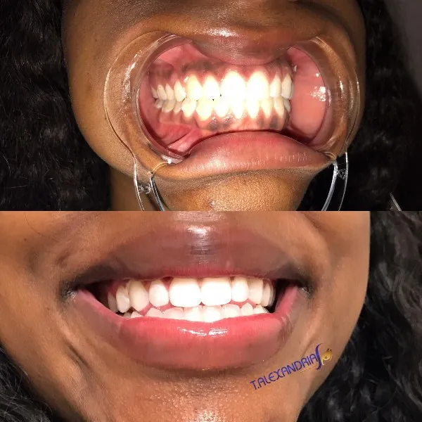 30786 home remedies teeth whitening alexandria