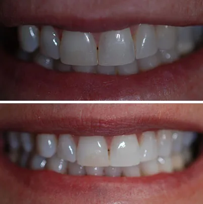 30786 maintaining white smile
