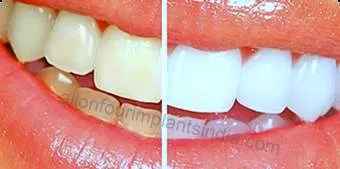 30787 in office whitening chennai