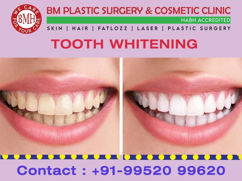 30787 teeth whitening cost comparison