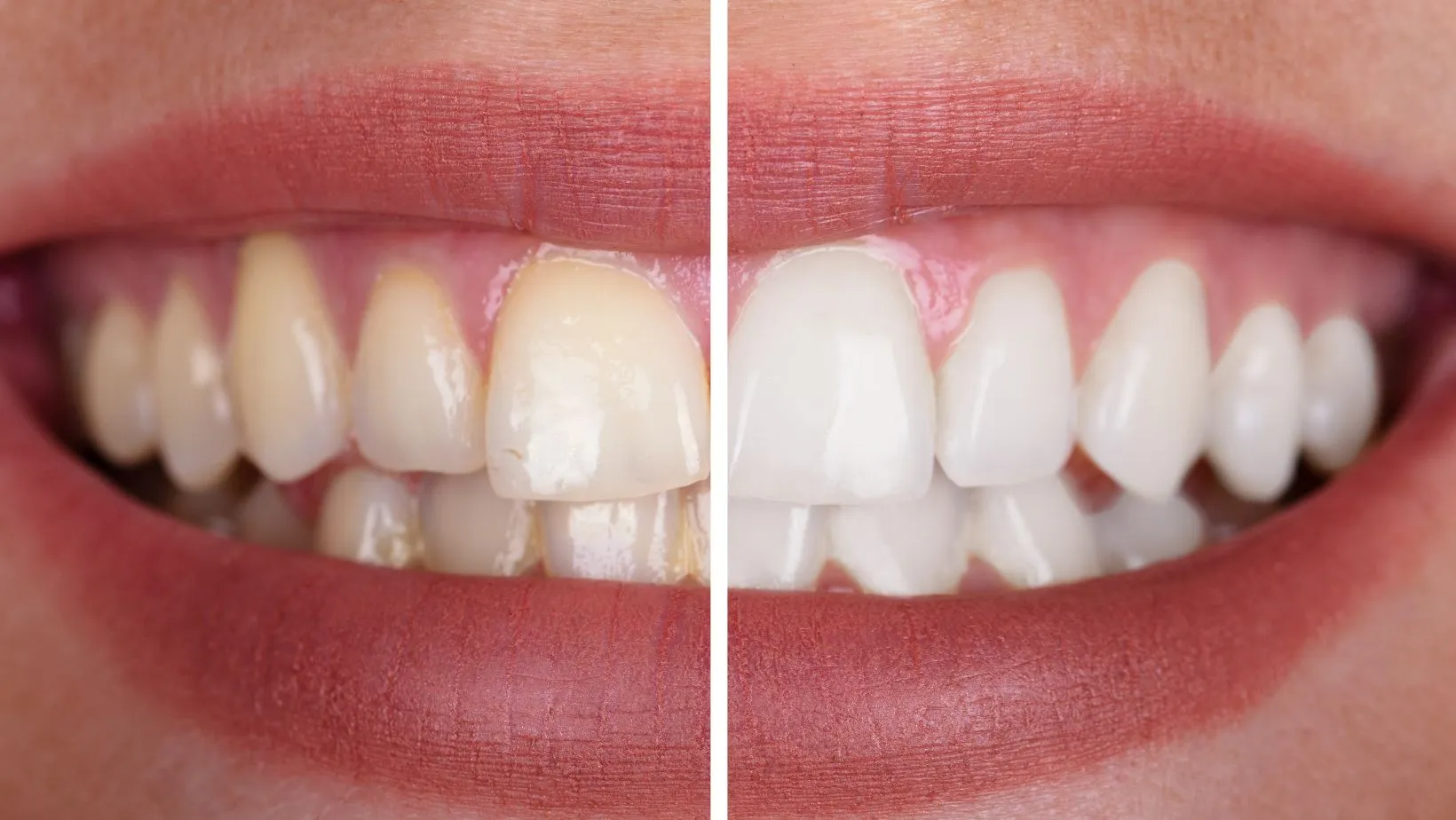 30801 professional teeth whitening