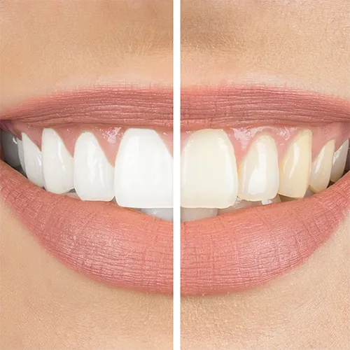 30801 teeth whitening sensitivity