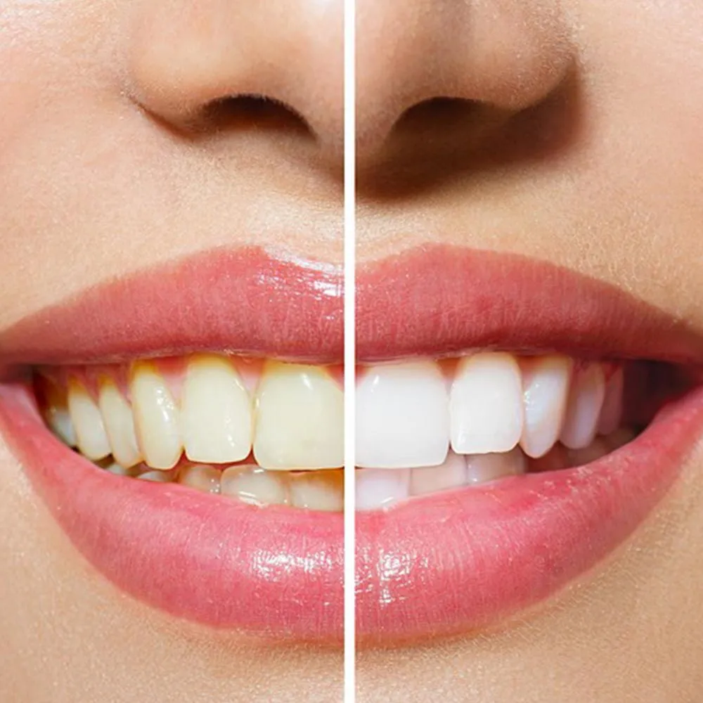 30806 in office teeth whitening