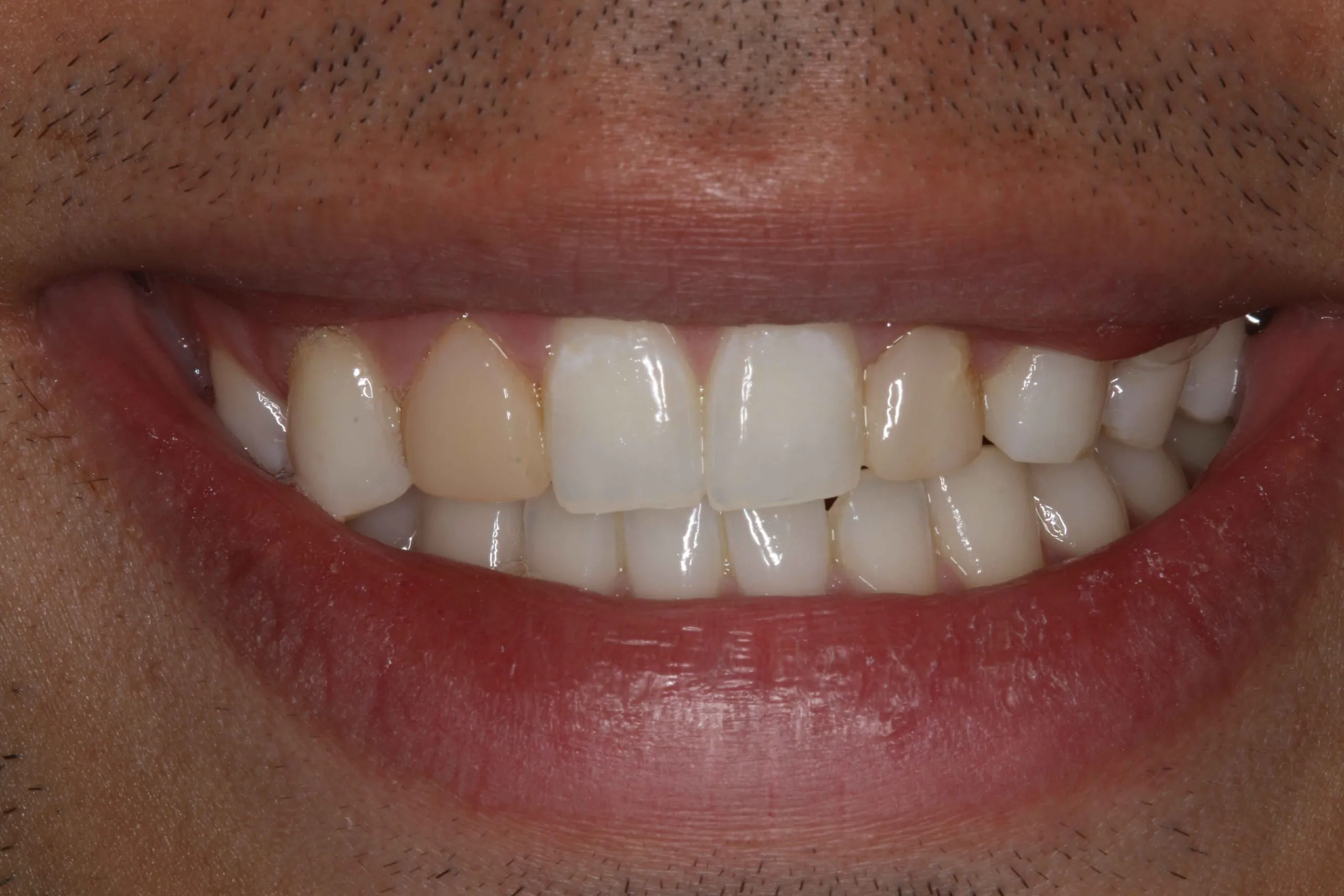 30807 composite resin application