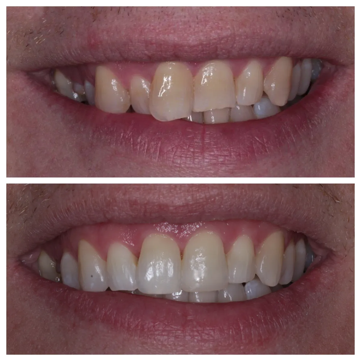 30807 composite shaping polishing