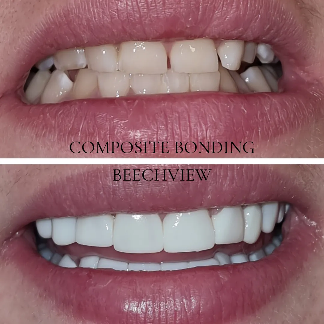 30807 teeth preparation