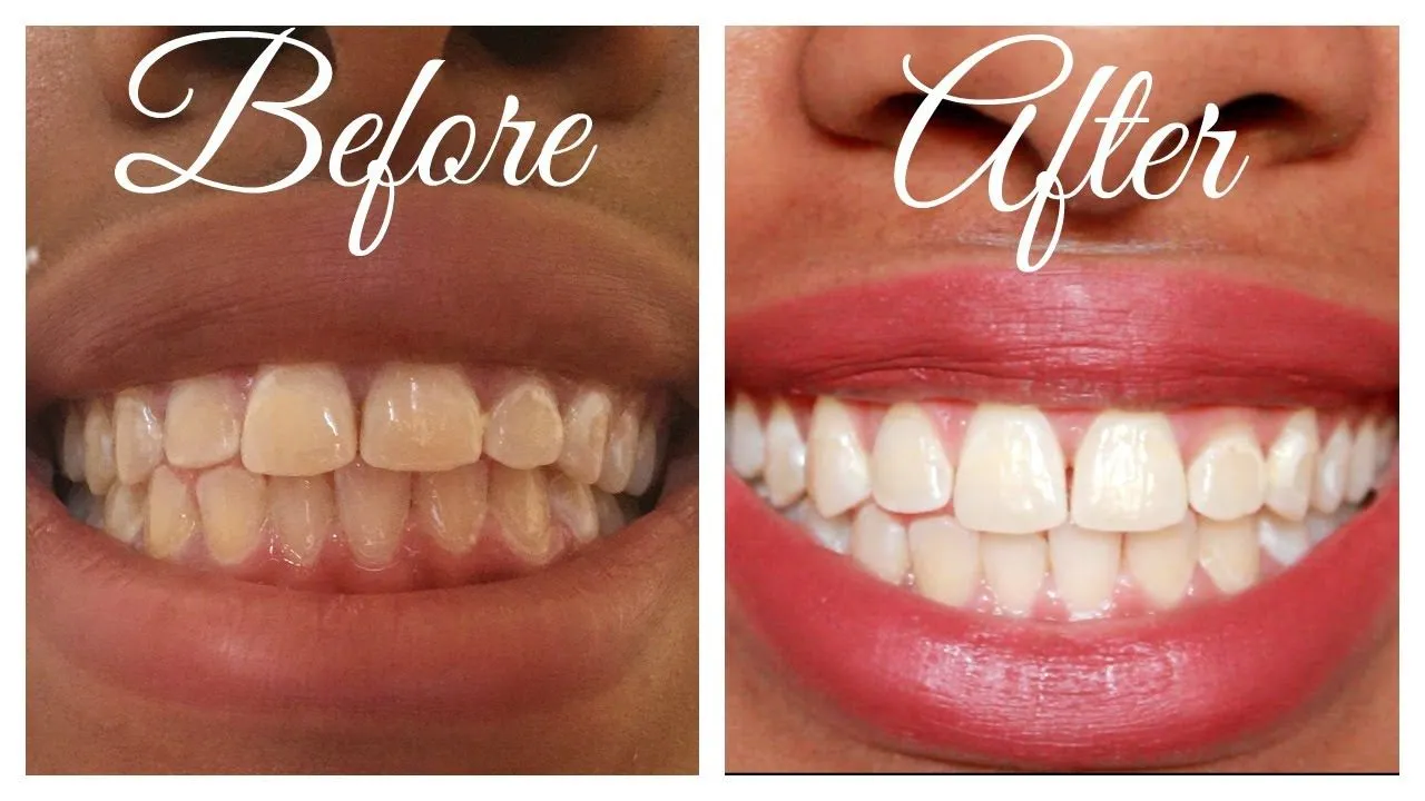 30811 at home whitening