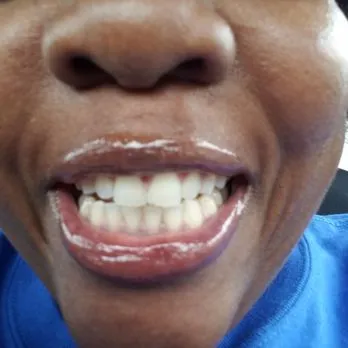 30815 in office teeth whitening