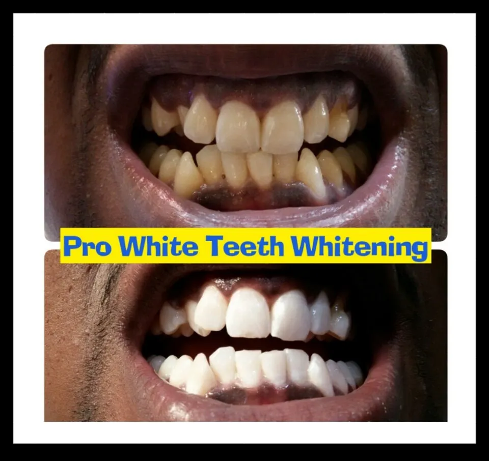 30815 teeth whitening options