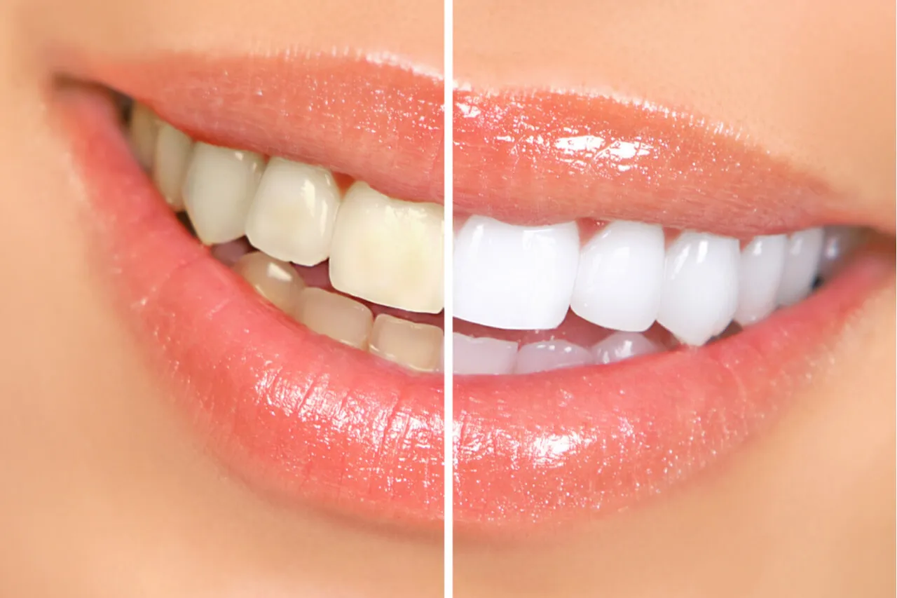 30817 teeth whitening effectiveness
