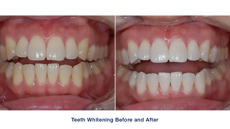 30817 teeth whitening maintenance