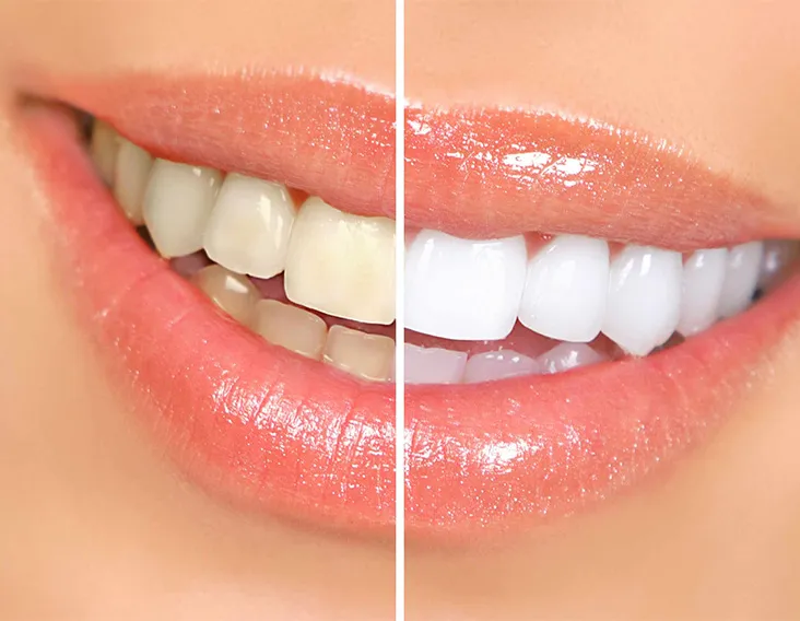 30822 in office teeth whitening burnaby