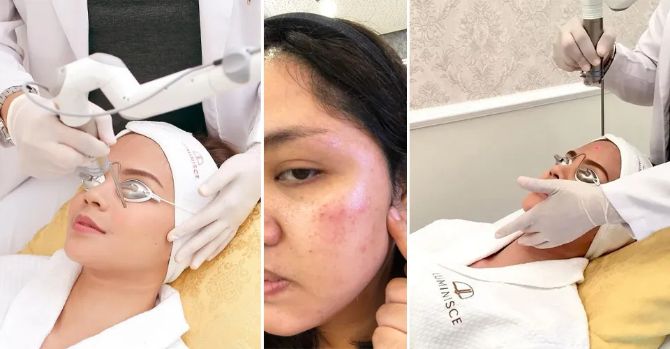 30848 angel whitening laser procedure