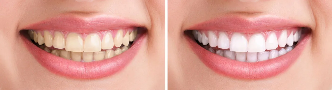 30851 west hollywood teeth whitening clinic