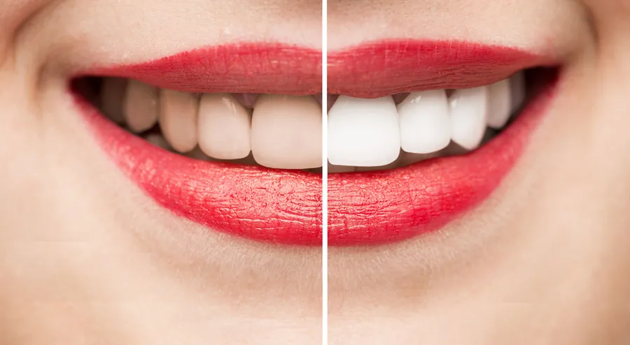 30866 mac teeth whitening overview
