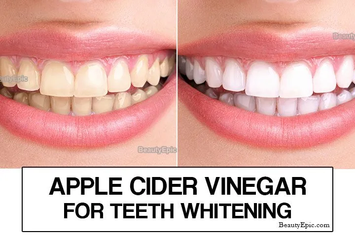 30866 teeth whitening science