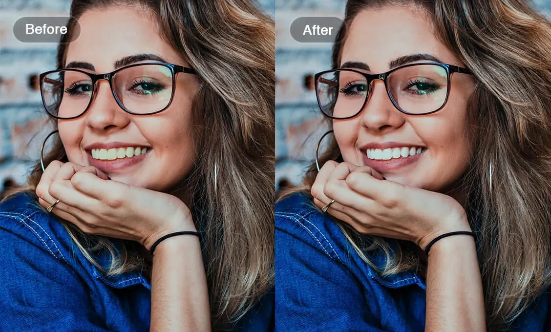 30870 teeth whitening treatment