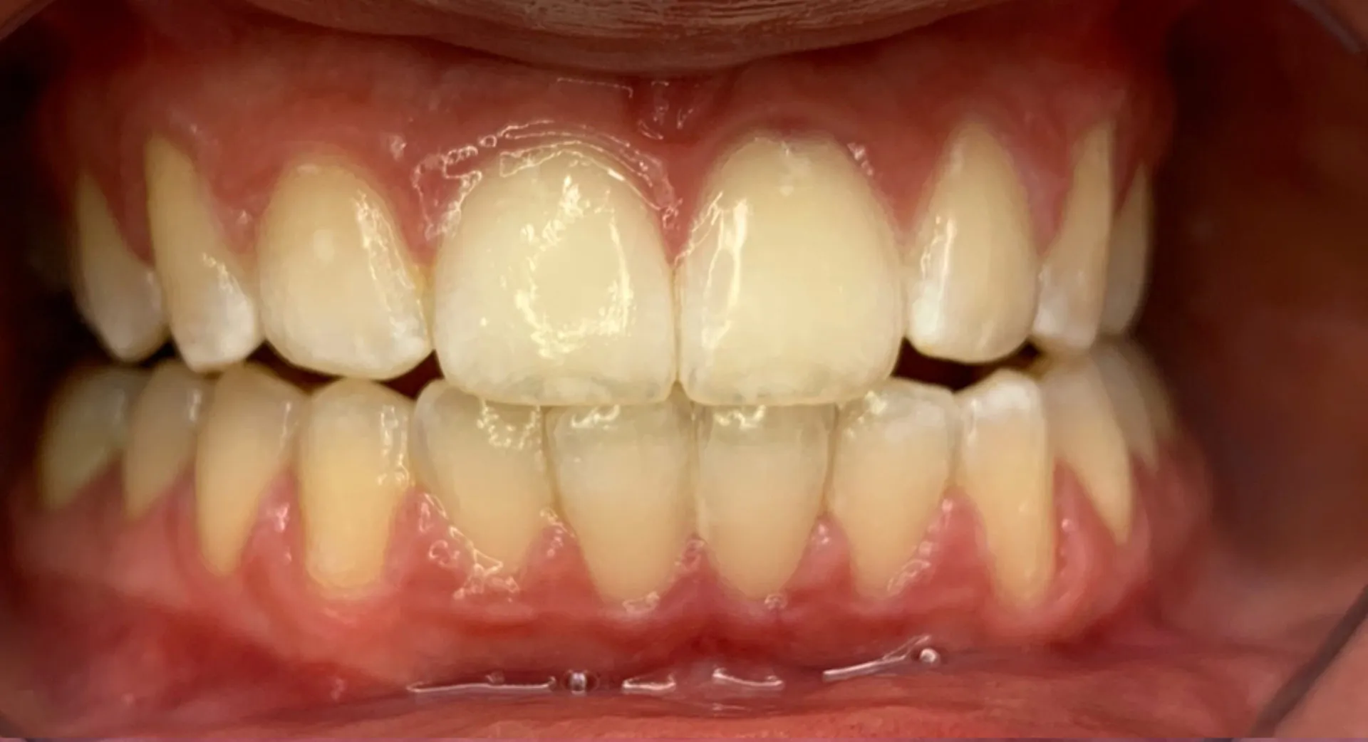 30872 teeth whitening mornington peninsula maintenance