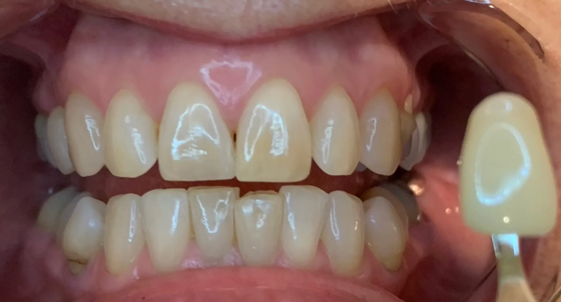 30872 teeth whitening mornington peninsula procedure