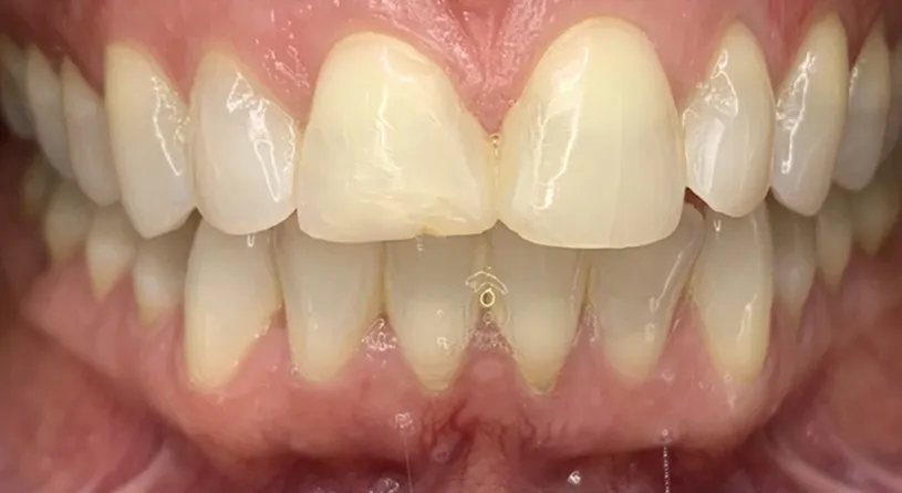 30872 teeth whitening mornington peninsula risks