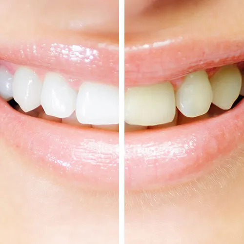 30879 in office teeth whitening
