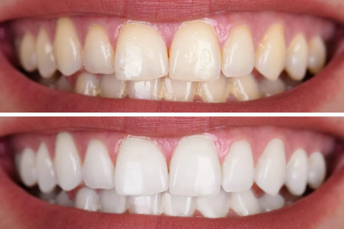 30879 professional take home teeth whitening