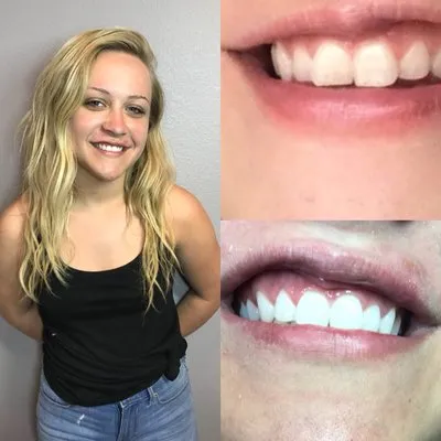 30884 before and after teeth whitening
