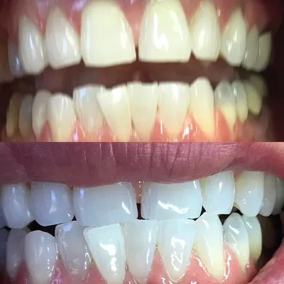 30884 teeth whitening procedure