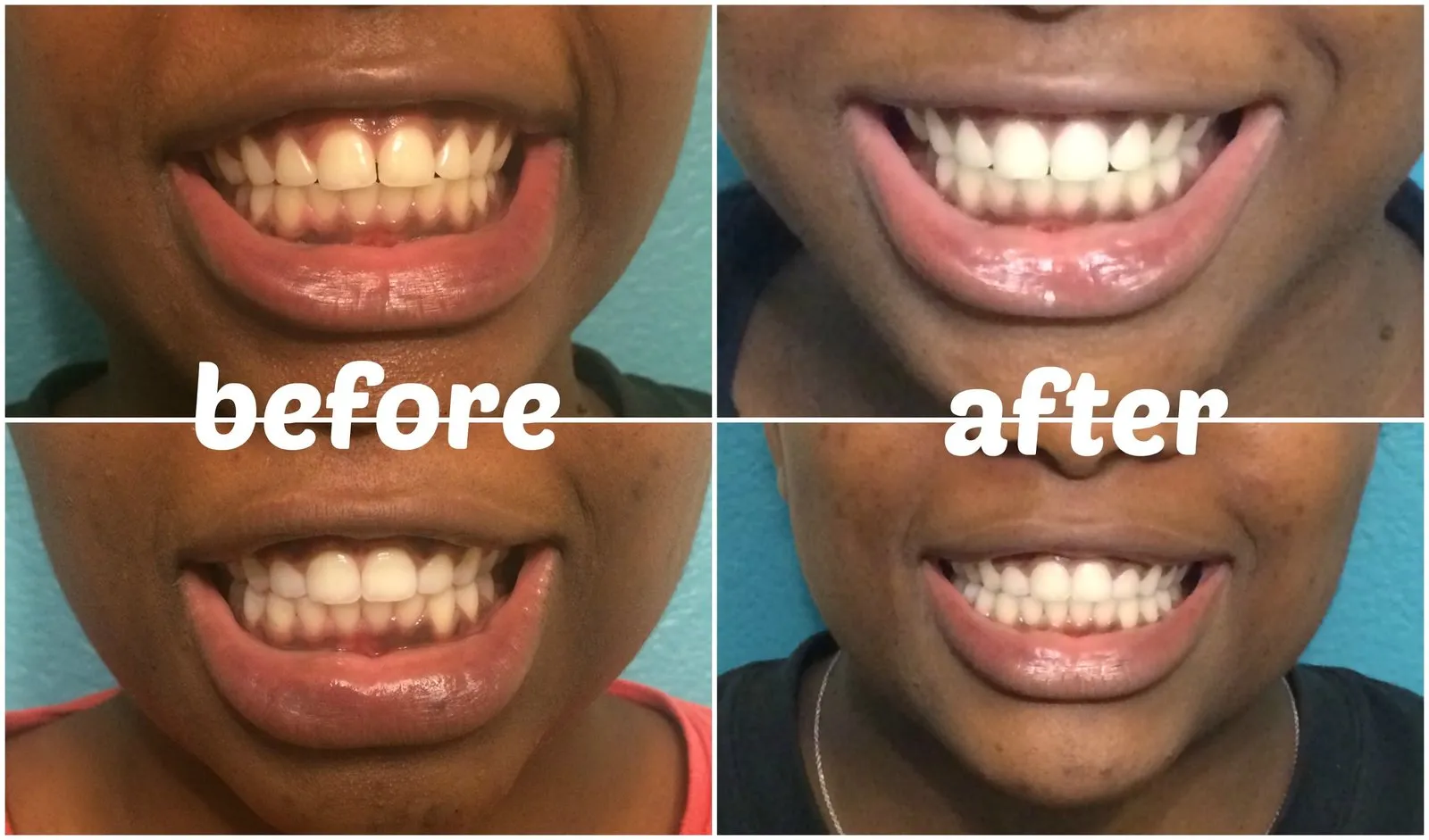 30885 activated charcoal before after