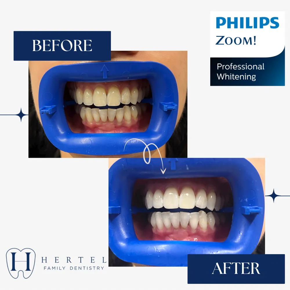 30891 boost confidence teeth whitening