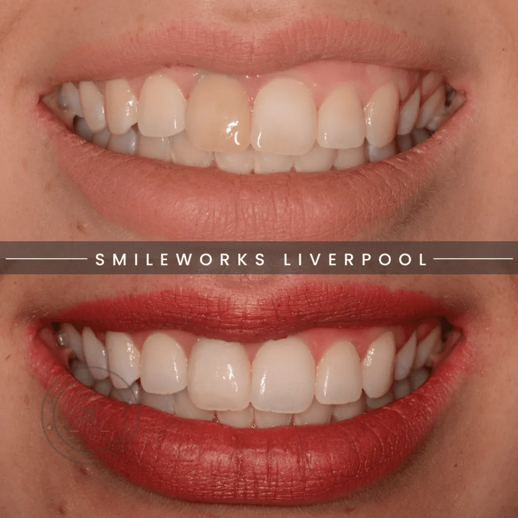 30904 impression teeth whitening uk 4