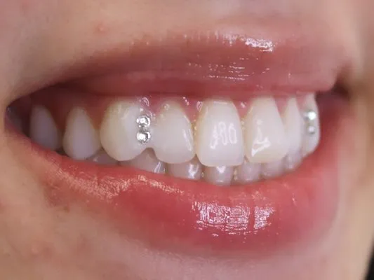 30908 teeth whitening stpaulmn in office