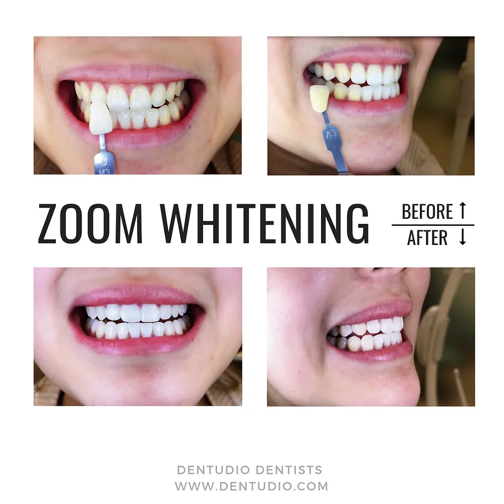 30913 avoid foods teeth whitening
