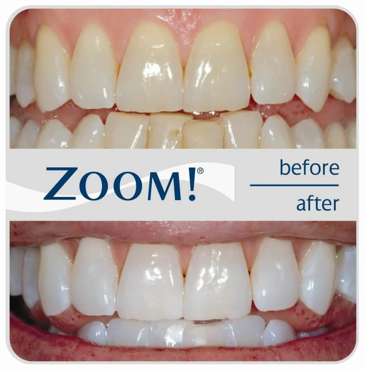 30913 teeth whitening treatment