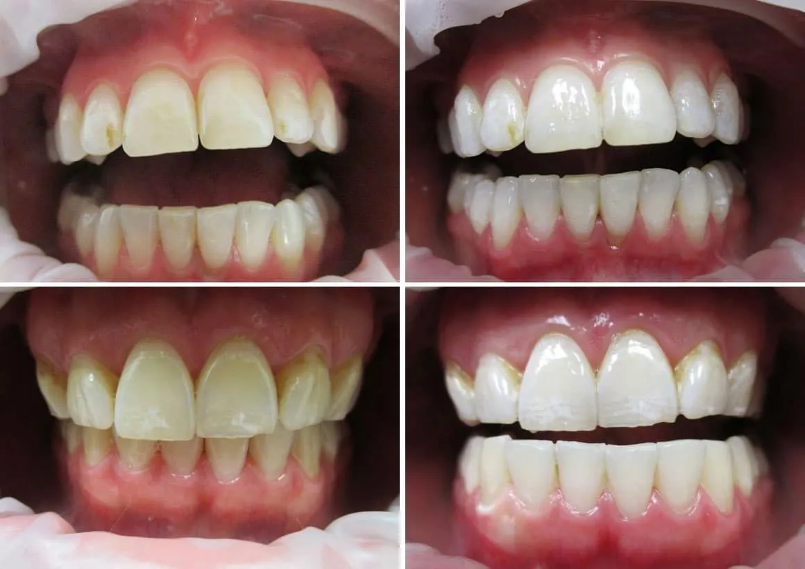 30914 at home teeth whitening