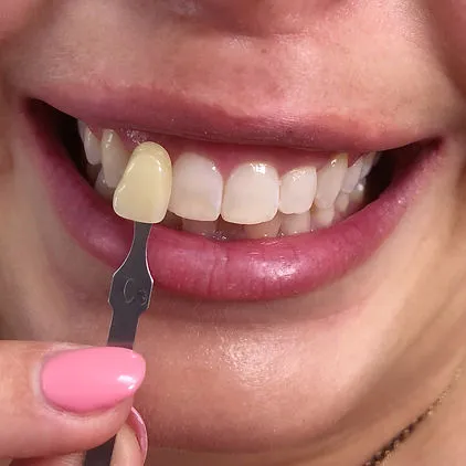 30914 teeth whitening before after