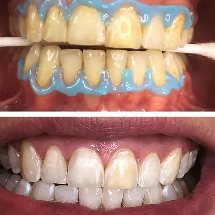 30914 teeth whitening custom trays