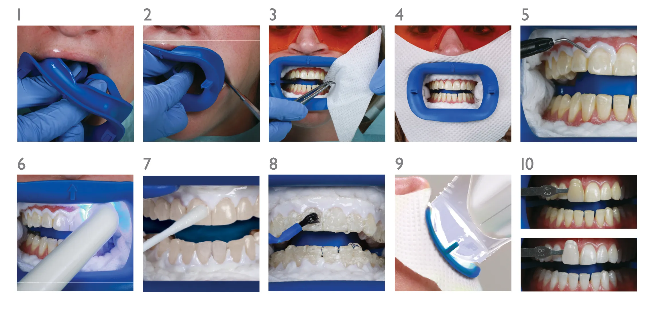 30918 inserting whitening trays