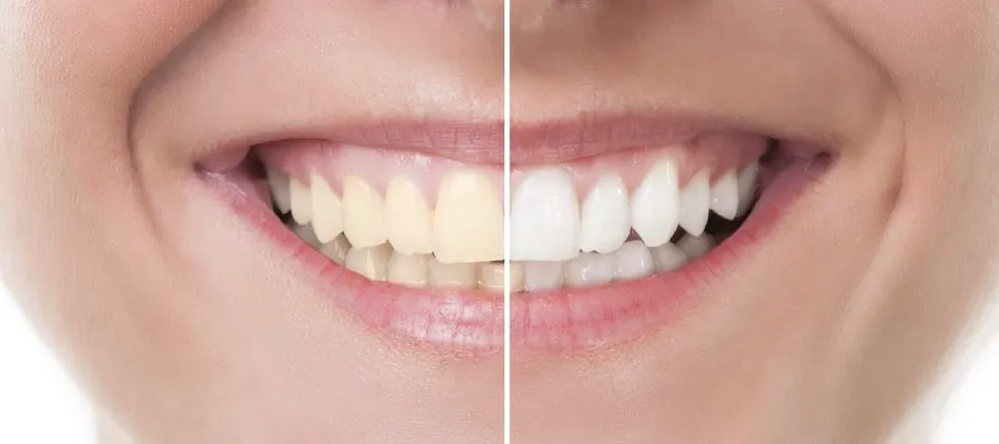 30920 bright smile confidence